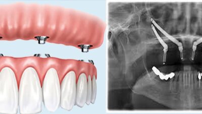 zygomatic implant dentures