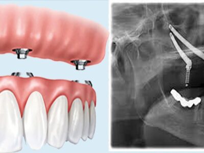 zygomatic implant vs dentures - Fixed Teeth in One Day