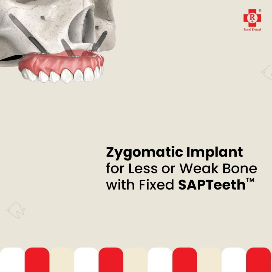 Dental Zygomatic implant