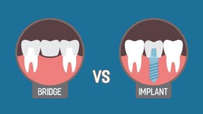implant vs bridge