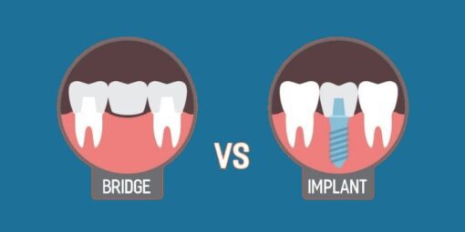 Bridge or Implant: What to opt for missing teeth? Royal Dental Clinics implant vs bridge
