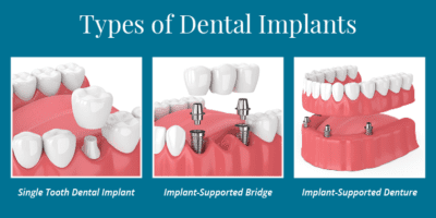 implants vs dentures vs bridges