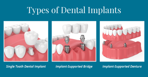 implants vs dentures vs bridges