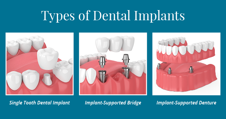 implants-vs-dentures-vs-bridges
