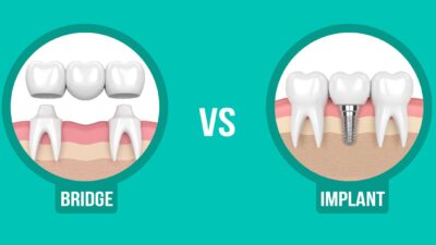 dental implant or bridge