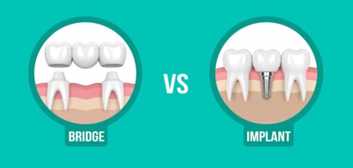 Bridge or Implant: What to opt for missing teeth? Royal Dental Clinics dental bridge or implant
