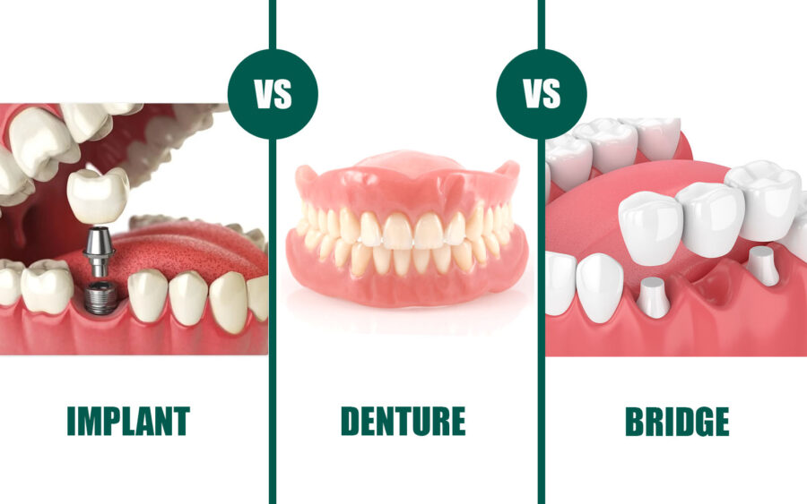 implant vs denture vs brudge