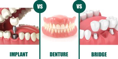 dental implant vs denture vs bridge