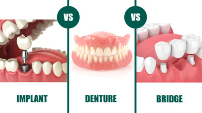 dental implant vs denture vs bridge
