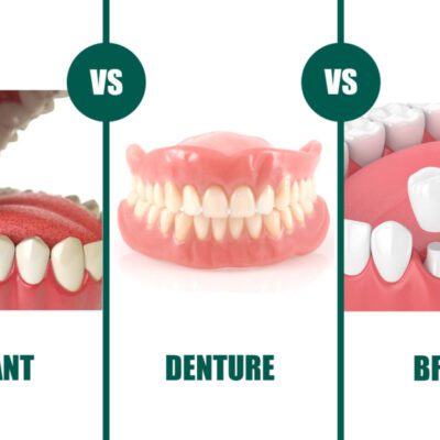 Dental Implants vs Bridges vs Dentures