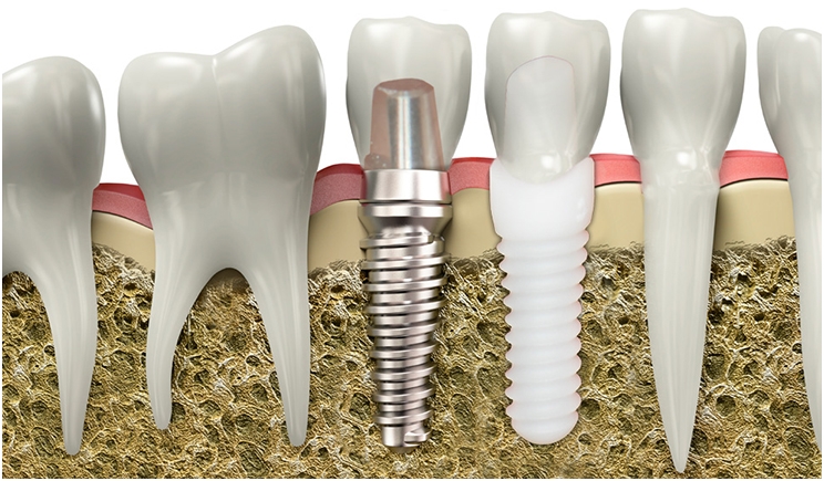zirconia-dental-implants