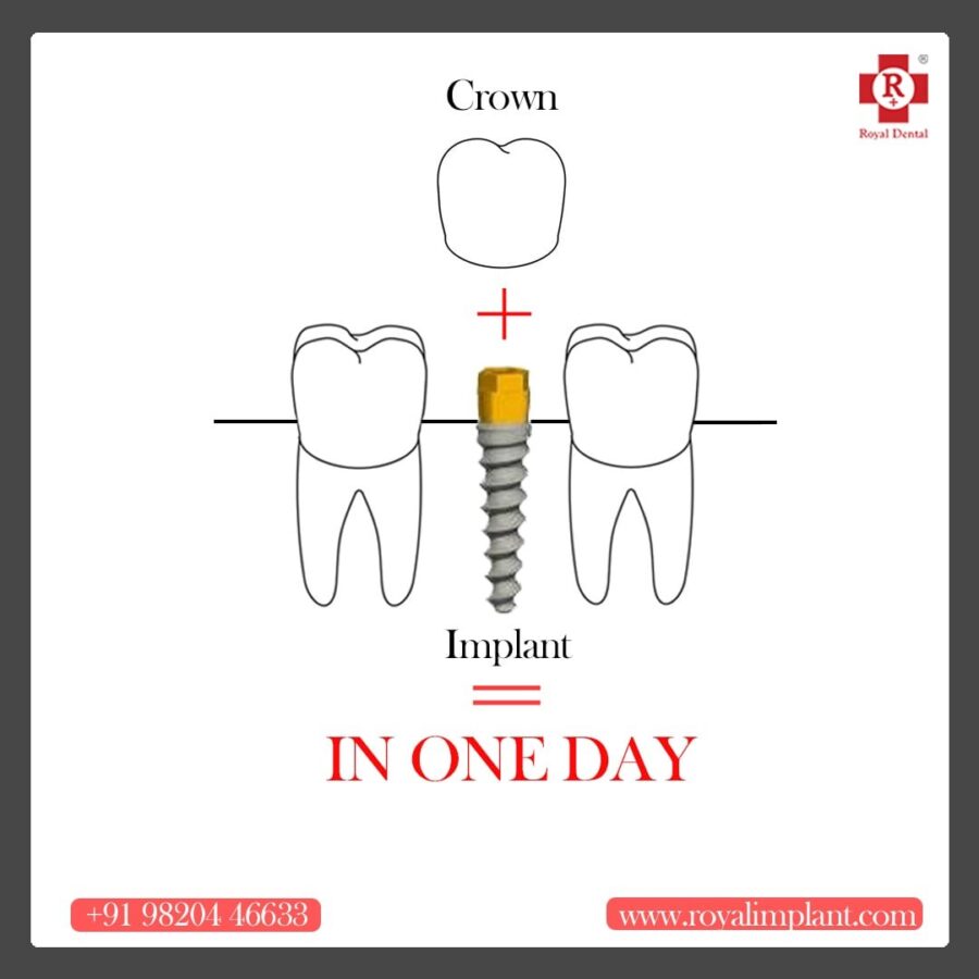 One day dental implant