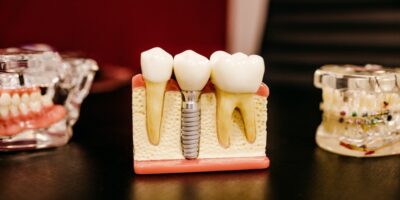 dental implants in bangalore