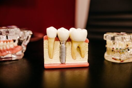 dental implants noticeable