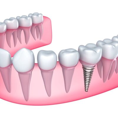 Fixed Teeth in One Day for Patients With No Teeth | Mumbai Royal Dental Clinics implant in bone - fixed teeth in one day