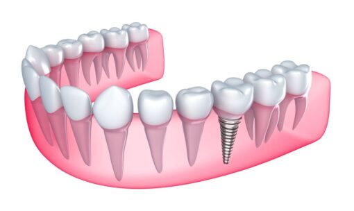 implant in bone