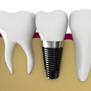 dental implant brands in india