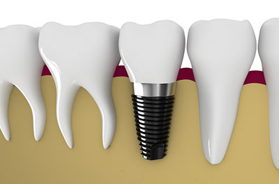 dental implant brands in india