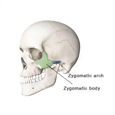 Zygomatic Implant Bone
