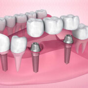 teeth implants bridge