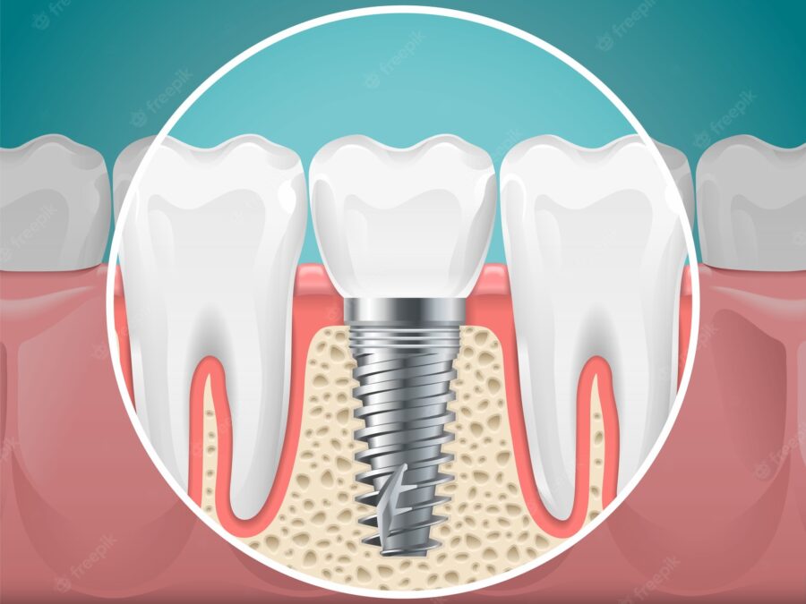 implant dentistry, smile dental