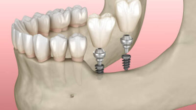 implant surgery in one day