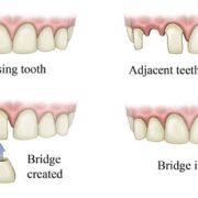 bridges types for missing tooth
