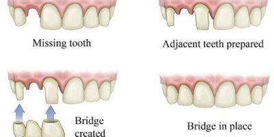bridges types for missing tooth