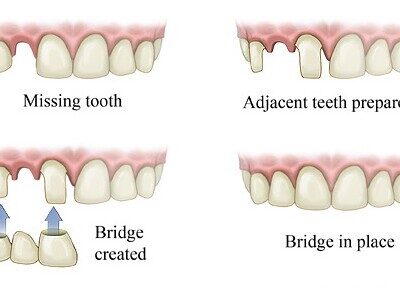 bridges types for missing tooth