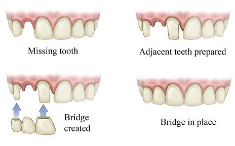 What-is-the-Cost-of-a-Dental-Bridge-in-India?