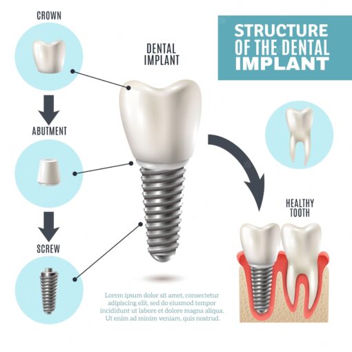 structure of dental implant