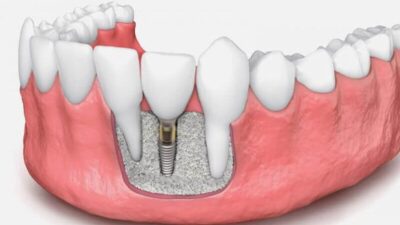 dental implants in one day