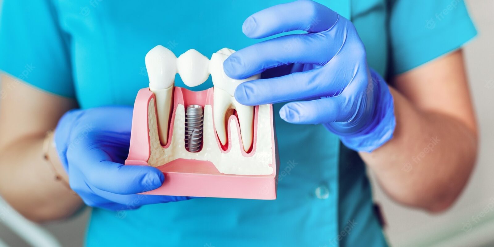 dental implants in chennai