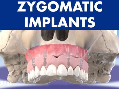 zygomatic implants