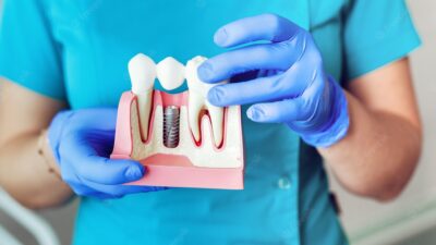 dental implants in chennai