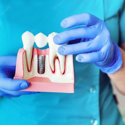 AI guide to Dental Restoration: 2026 redefines precision Royal Dental Clinics dental implants in chennai - AI guide to Dental Restoration