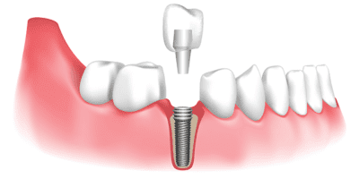 Dental crown with implant