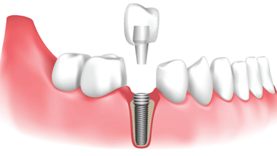 Dental crown with implant