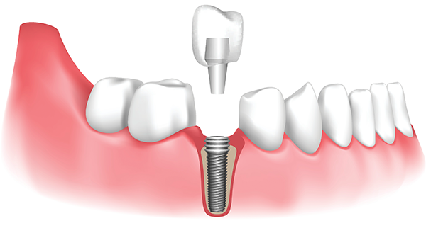 Dental crown with implant