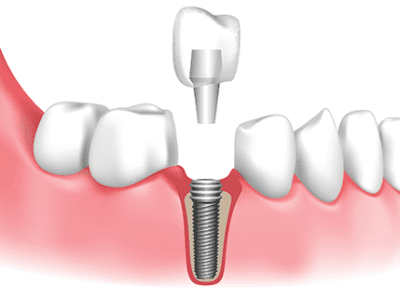 one day dental implant
