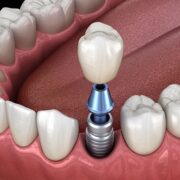 Dental Implant Failure in Mumbai: Causes, Symptoms and Treatment Royal Dental Clinics Implant with abutment - dental implant failure