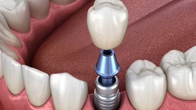 Dental Implant Failure in Mumbai: Causes, Symptoms and Treatment Royal Dental Clinics PEEK Implant with abutment - dental implant failure