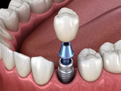 Dental Implant Failure in Mumbai: Causes, Symptoms and Treatment Royal Dental Clinics royal implant Implant with abutment - dental implant failure