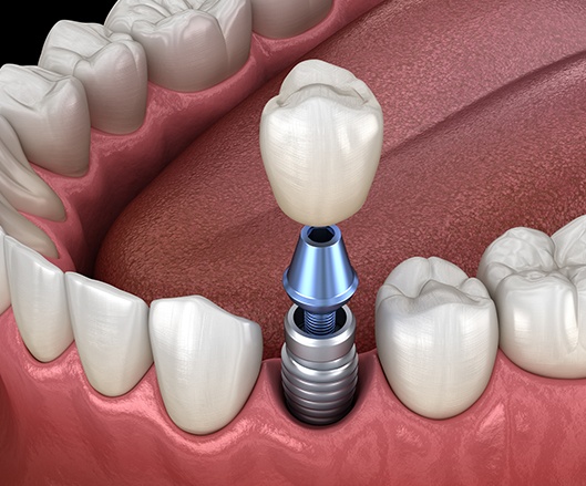 Implant with abutment
