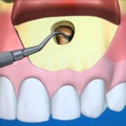 Apicoectomy Procedure Dental