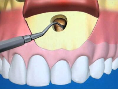Apicoectomy Procedure Dental