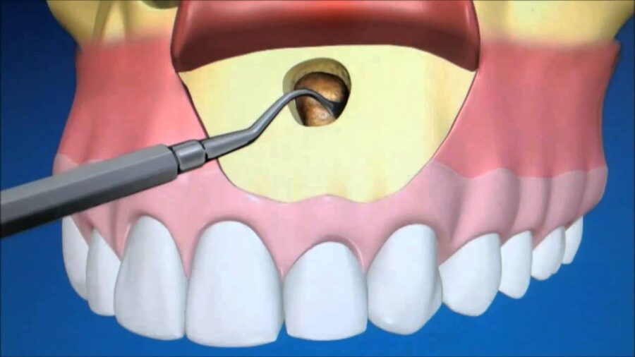 Apico Dental Procedure