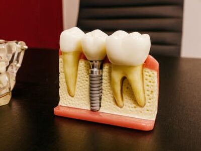 single dental implant