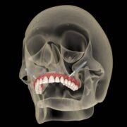 zygomatic dental implants in Mumbai