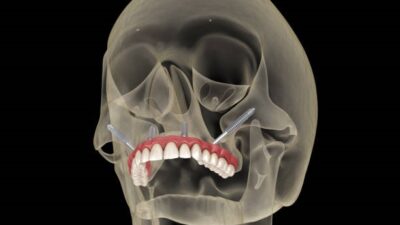 zygomatic dental implants in Mumbai